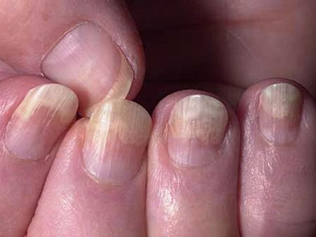 Nail Infection