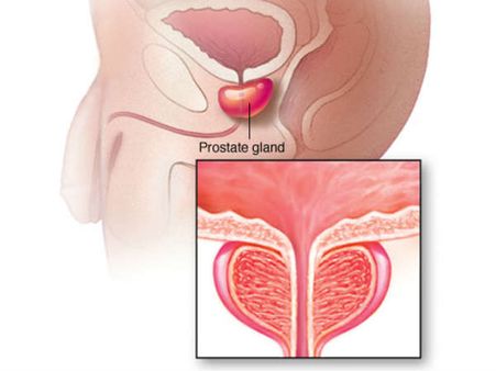 Does Prostate Cancer Kill?