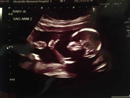 She Was Aborted In Her 3rd Trimester…