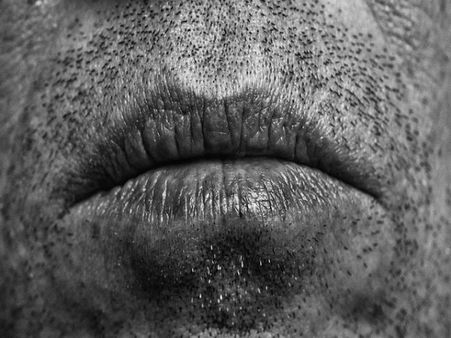 #2 Unhealing Sores in the Mouth and Lips