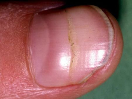 #8 Horizontal Indents and Grooves