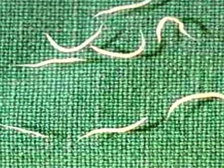 #2 Threadworms #2 Threadworms