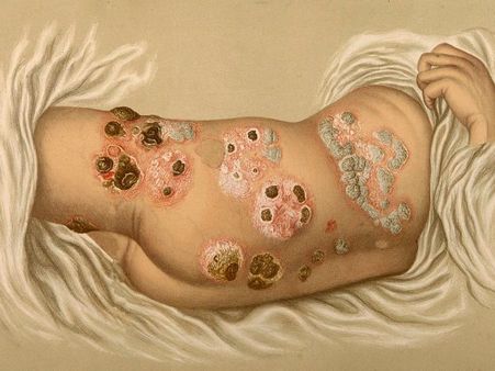 #3 Eczema or Psoriasis #3 Eczema or Psoriasis