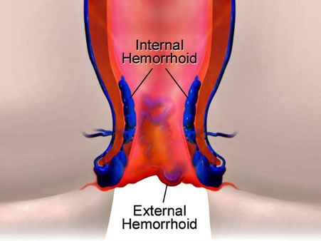 #4 Hemorrhoids or Piles #4 Hemorrhoids or Piles