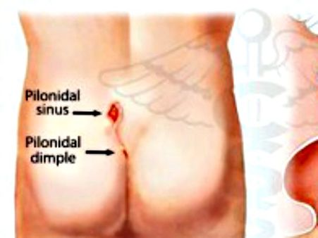 #6 Pilonidal Sinus #6 Pilonidal Sinus