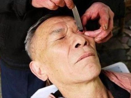 The Practice Is Known As “knife-blade Eye Cleaning” 
