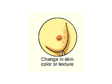 #2 Change in Texture of Your Breast
