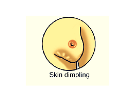 #4 Dimpling of Breast