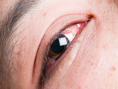 4. Snoozing In Contact Lens; 4. Snoozing In Contact Lens;