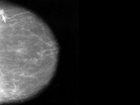 9. Fine-Needle Aspiration: