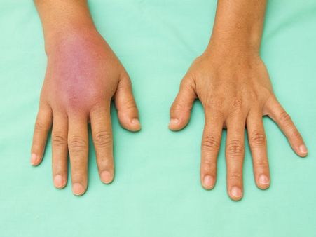 Benefit #9: Reduces swelling. 