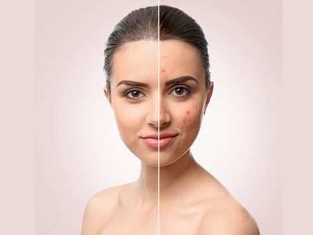 #16 It can get rid of acne. 