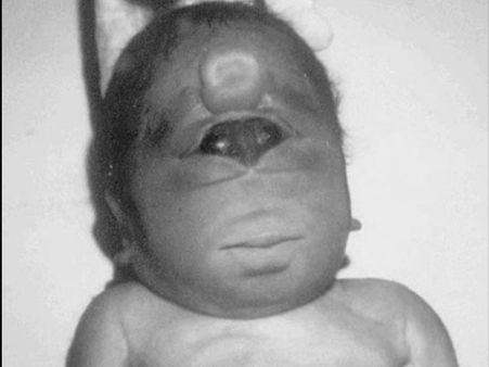 The Baby With A Single Eye!