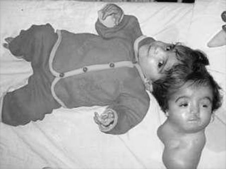 Babies Attached At Head!