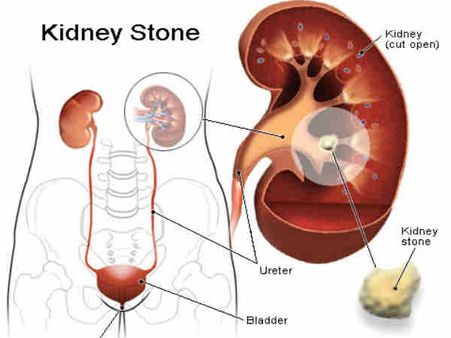 10. Kidney Stones: