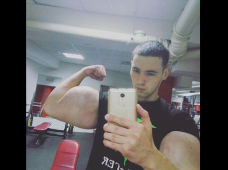 He Injected 250 ml Each Day!