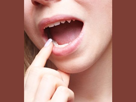 • Cures Mouth Ulcer: • Cures Mouth Ulcer: