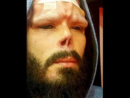 He Even Got His Nose Removed!