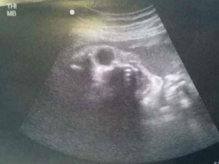 Picture#5 The Skeleton Baby!