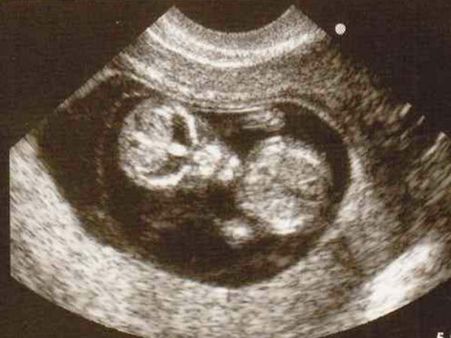 Picture# 1 The Alien Baby!