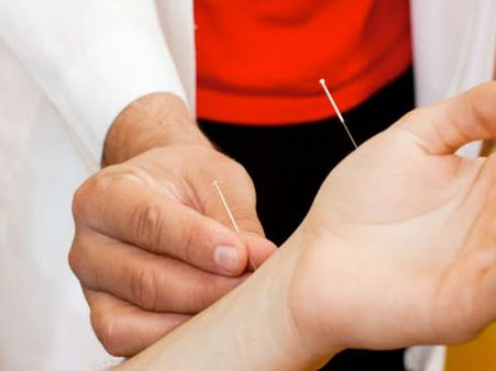 6. Try Acupuncture 6. Try Acupuncture