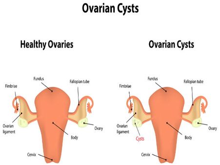 6. There Are More Than 30 Types Of Ovarian Cancer