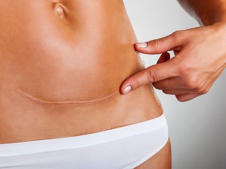 Women With Twins Are More Likely To Deliver Via A C-Section