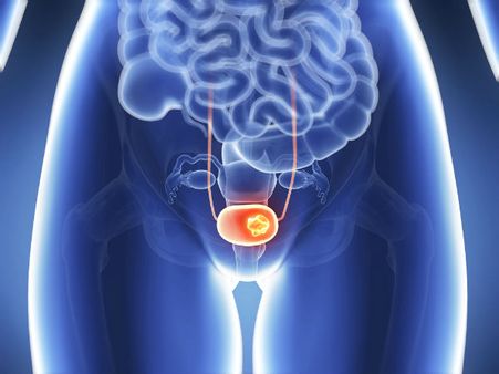 How To Prevent A Bladder Infection