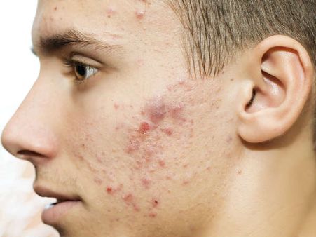 #3 Your Skin Is Breaking Out 