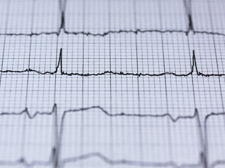 Cardiac Arrest vs Heart Attack: Are The Two Linked?