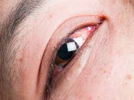 She Was Suffering From Conjunctival Concretions