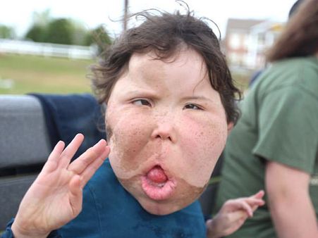 She Was Initially Diagnosed With Megalencephaly She Was Initially Diagnosed With Megalencephaly