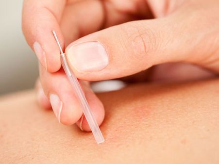 Acupressure and Acupuncture