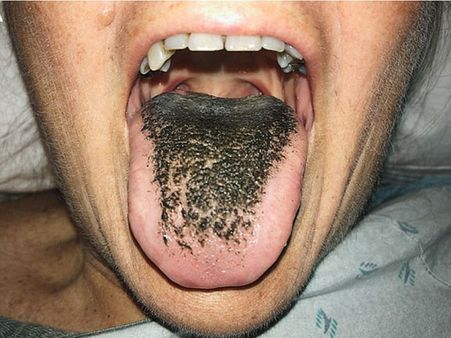 What Is A Black Tongue?