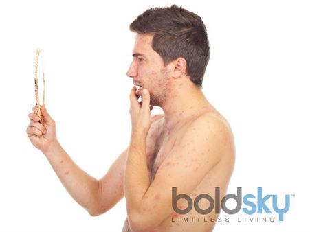 How Do You Contract Shingles?