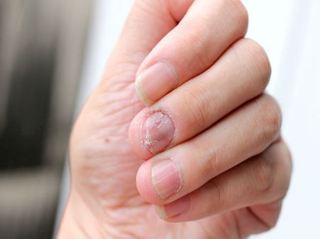 For Fungal Infections