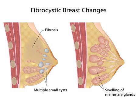 3. Fibrosis And Simple Cysts