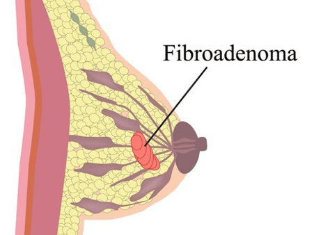4. Fibroadenomas