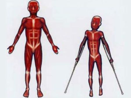Types Of Muscular Dystrophy