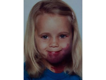 About Port Wine Stains