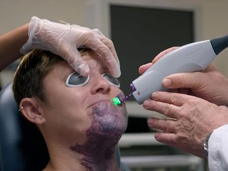 She Is Undergoing Laser Therapy Now