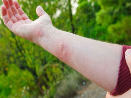 Symptoms Of Tick-borne Illnesses