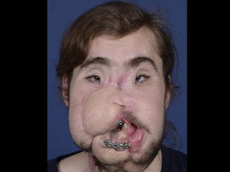 Cameron Underwood’s Mother Had Registered Him At A Face Transplant Unit