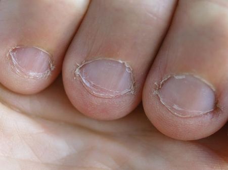 If Nails Are Yellow And Brittle