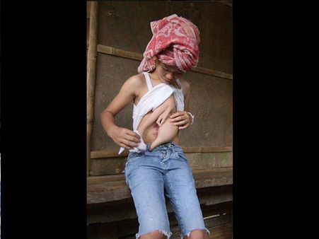 She Was Born With Her Parasitic Twin