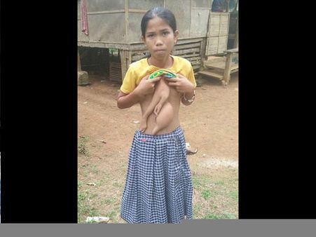 The Parasitic Twin Has Been Growing