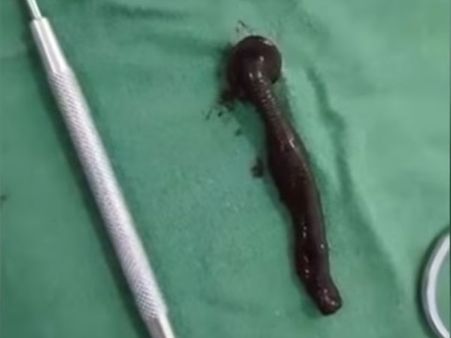 The Leech Was Pulled Out From The Woman’s Throat