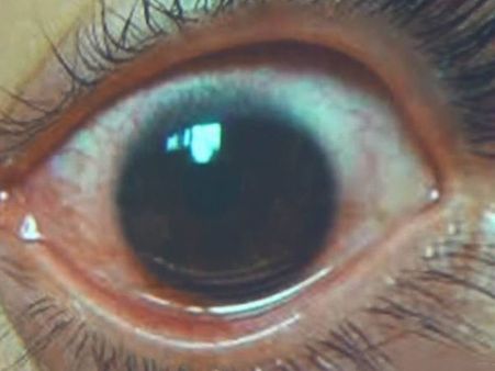 She Was Diagnosed With 500 Holes In Her Eyes!