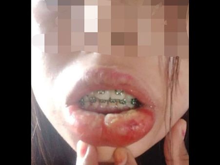 The Patient Tried It To Make A Fashion Statement!