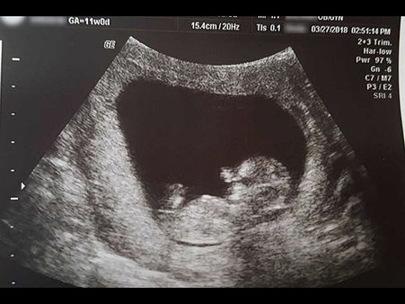 She Was Denied To Bury The Foetus As It Was Illegal!